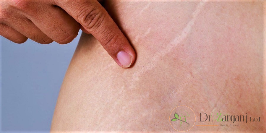 مزایای کربوکسی تراپی بر روی شکم