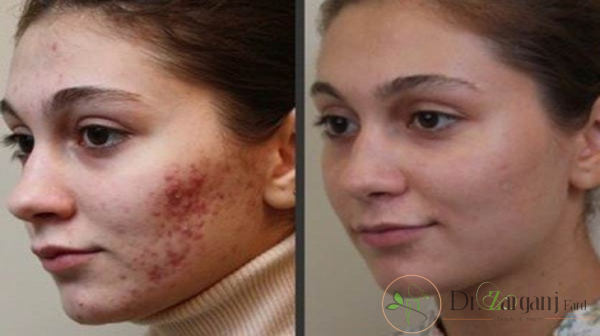 کربوکسی تراپی صورت جای جوش