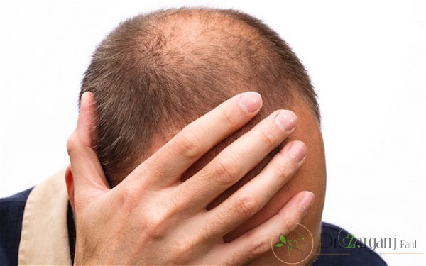 مزونیدلینگ در درمان ریزش مو