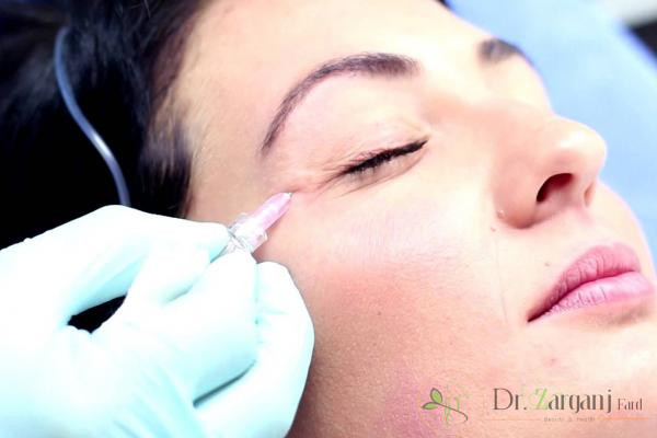 کربوکسی تراپی