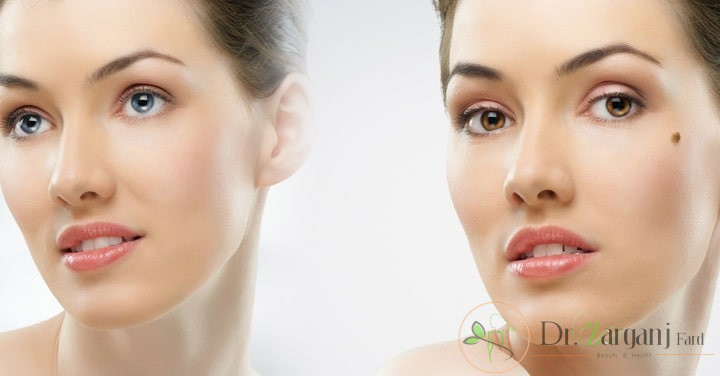 پس از برداشتن خال با لیزر در کلینیک پوست، باید چه مراقبت هایی صورت بگیرد؟