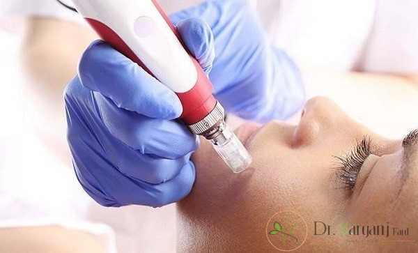 مزونیدلینگ چیست ؟
