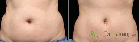 چه افرادی میتوانند از کربوکسی تراپی شکم استفاده کنند ؟