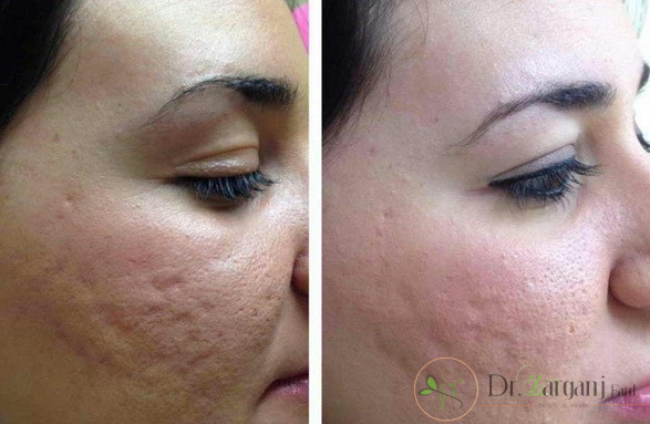 چه تعداد جلسه برای حصول نتیجه ی خوب از مزونیدلینگ لازم است ؟