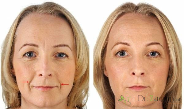 تزریق بوتاکس خط خنده چه مزیت های مهمی دارد؟