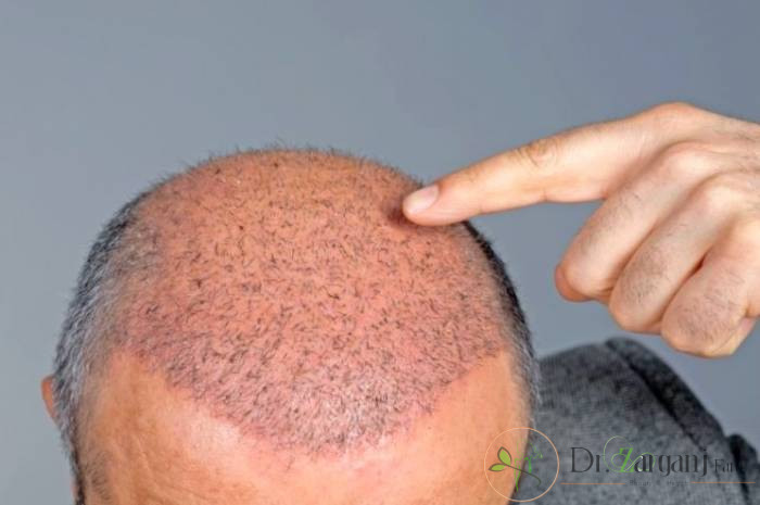 قبل از کاشت مو در بهترین کلینیک زیبایی تهران چه اطلاعاتی لازم است در اختیار داشته باشید؟