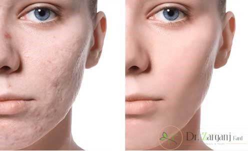 مزوندلینگ برای کدام اندام ها مفید است