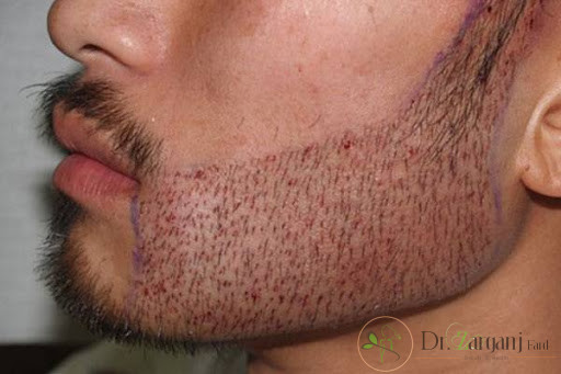 کاشت ریش برای آقایان در بهترین کلینیک زیبایی در چه شرایطی و چگونه انجام می شود؟