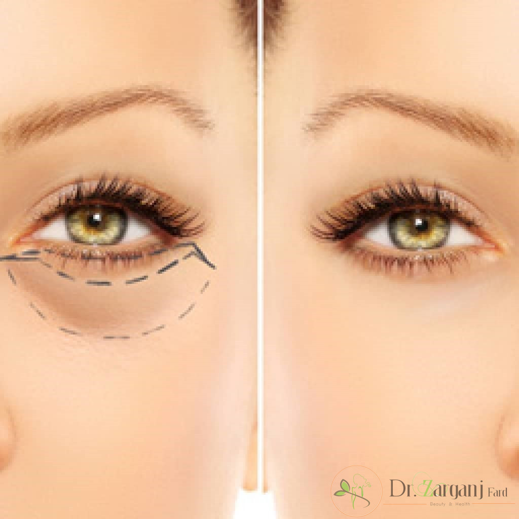 کربوکسی تراپی یک نوع از مزوتراپی است