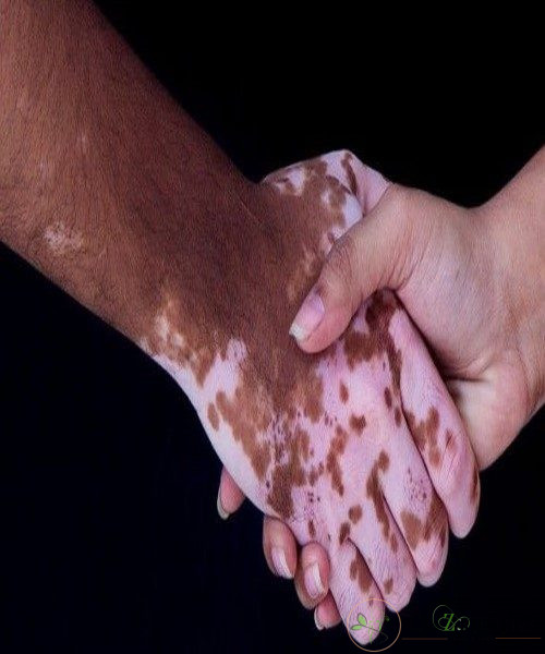 متخصص بیماری های پوستی بیماری پوستی پیسی را چگونه درمان می کند؟