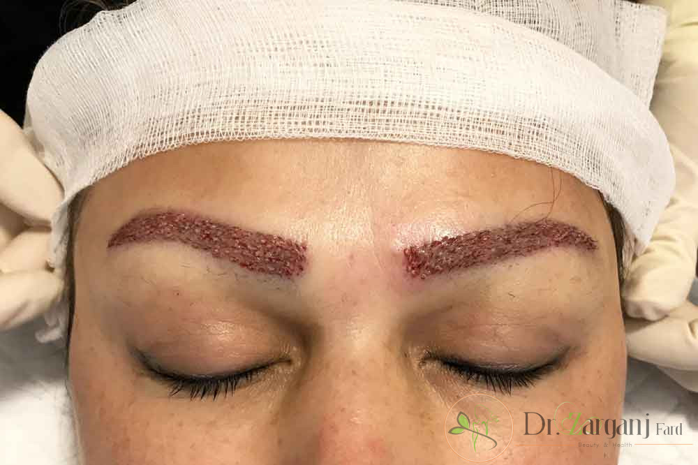 کاشت ابرو که به عنوان یک عمل زیبایی در بهترین کلینیک های زیبایی انجام می شود چگونه است؟