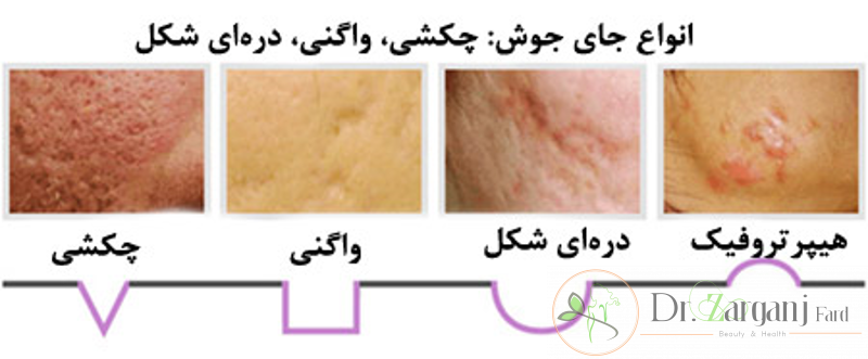 انواع جای جوش