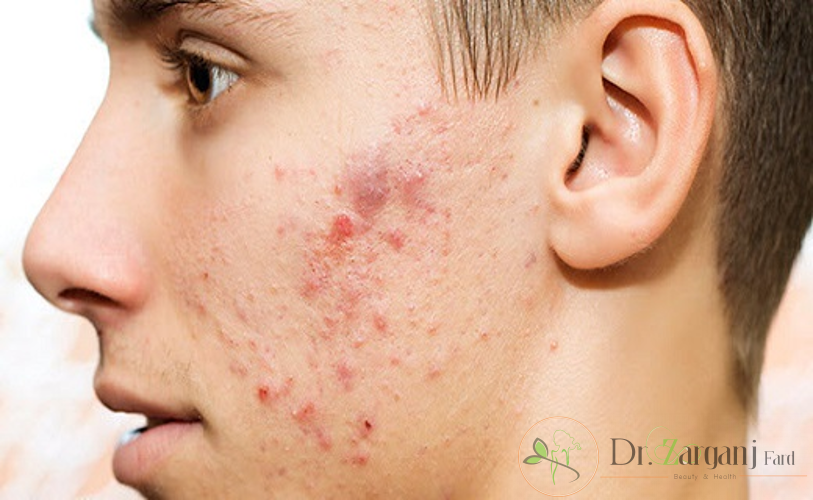 موارد استفاده کربوکسی تراپی جای جوش صورت