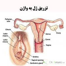 تزریق ژل به واژن چگونه انجام می شود ؟