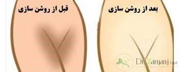 دلایل تیرگی واژن چیست و چه راه کارهایی برای رفع تیرگی و روشن سازی پوست واژن وجود دارد؟