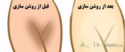 لیزر مونالیزا برای رفع تیرگی