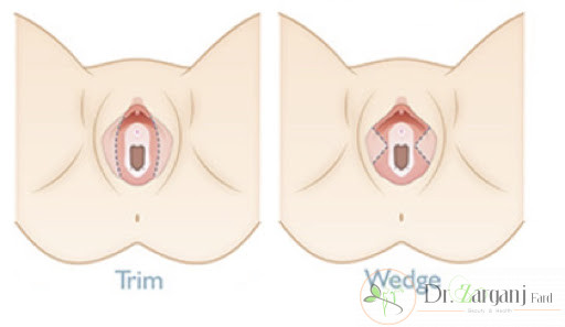 - تکنیک wedge در لابیاپلاستی به چه صورت می باشد ؟