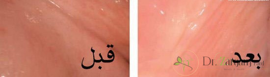 رنگ طبیعی ناحیه تناسلی