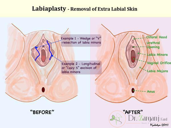 - علت محبوبیت عمل زیبایی لابیاپلاستی چه چیزی می باشد ؟