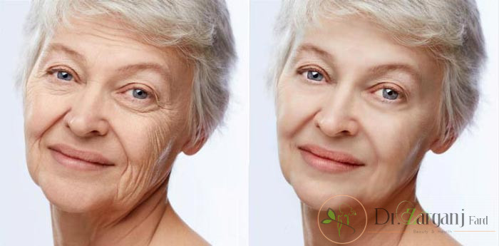 تزریق ژل برای چه نقاطی از بدن مناسب می باشد؟