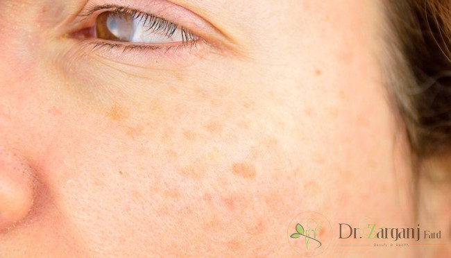 رنگدانه های پوستی چگونه با استفاده از لیزر از بین می روند؟
