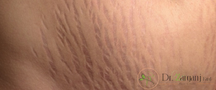 روش انجام کربوکسی تراپی ترک های پوست چه فرآیندی دارد؟