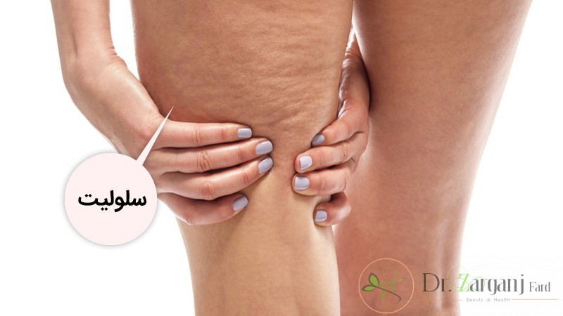 کربوکسی تراپی کشاله ران