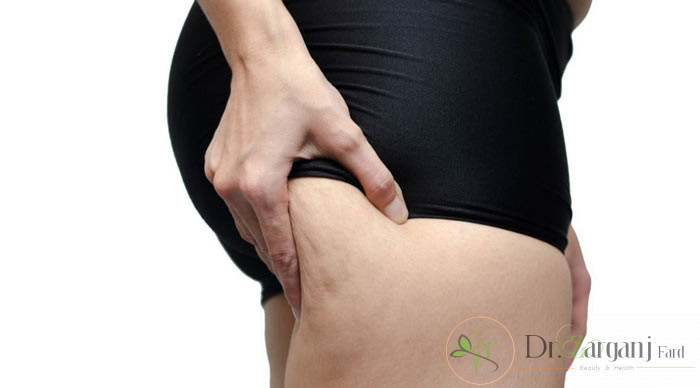 روش کربوکسی تراپی ترک های پوست برای چه بخش هایی از بدن توصیه می شود؟