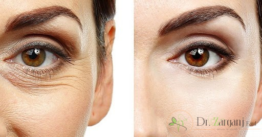 عوارض پلاسما جت چیست؟