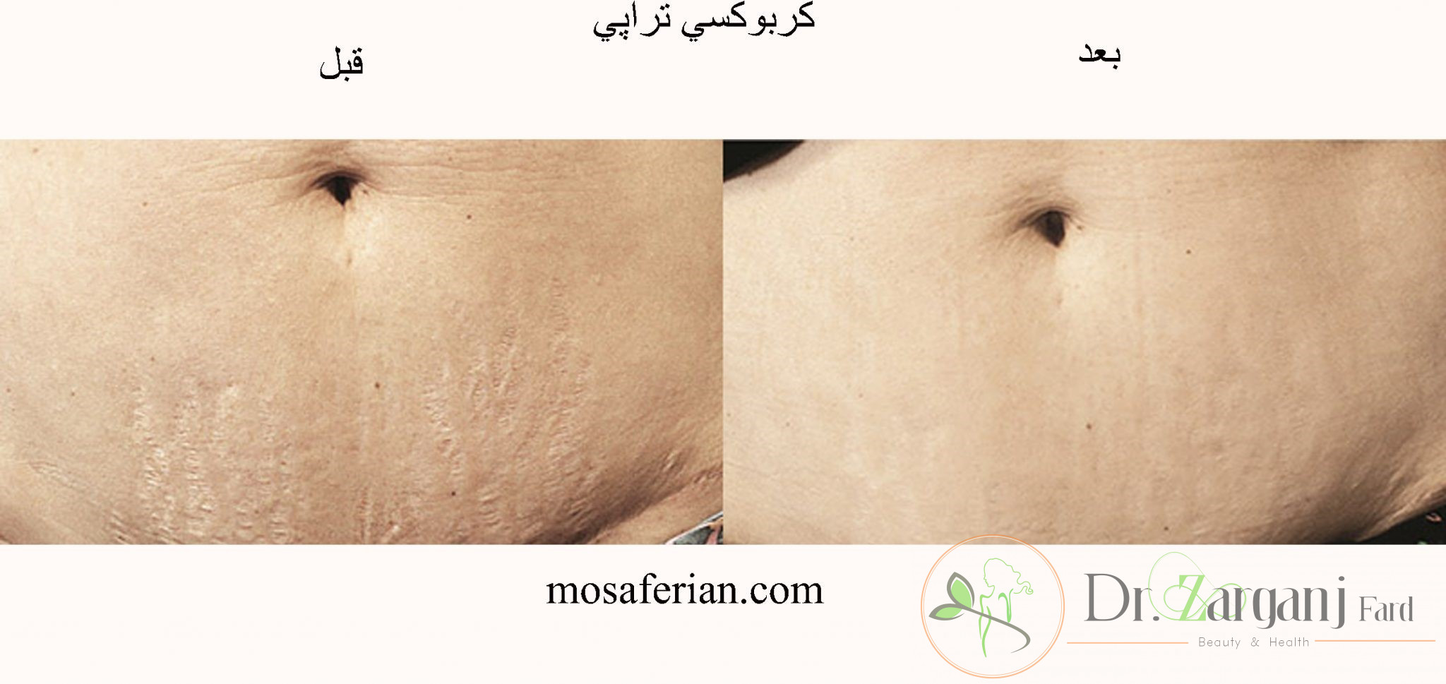 آیا میدانید با تزریق گاز دی اکسید کربن پوست چگونه زیبایی خود را به دست میآورد؟
