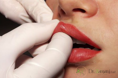 چگونه می توان از گوله شدن ژل بعد از تزریق ژل جلوگیری کرد؟