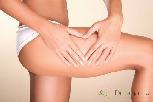 کربوکسی تراپی روی ترک های پوستی کشاله ران چه تأثیری دارد؟