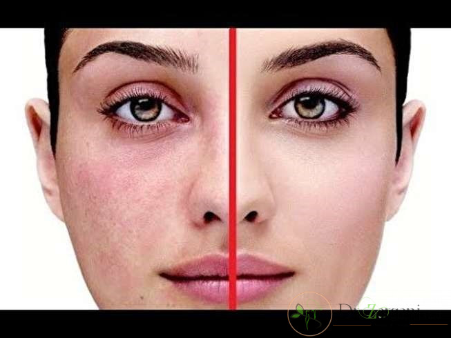از بین بردن رنگدانه های پوستی با استفاده از لیزر چه قیمتی دارد؟