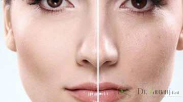 آیا با کربوکسی تراپی دور چشم آشنا هستید و به چند جلسه نیاز دارد؟