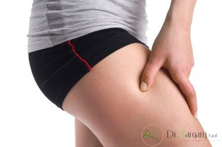 در رابطه با کربوکسی تراپی درمان سلولیت در ناحیه کشاله ران و باسن چه میدانید؟
