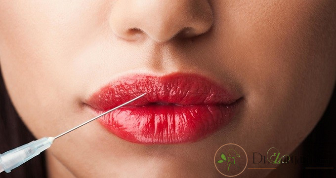 مزیت هایی که برای انجام دادن ژل لب وجود دارد، کدام موارد هستند؟