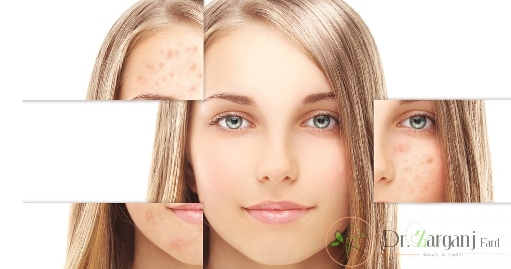چه نوع لیزرهایی برای از بین بردن لکه های پوستی و روشن کردن پوست وجود دارند؟
