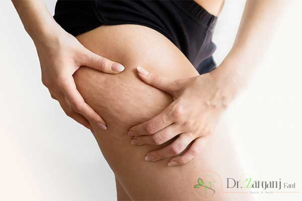 انجام روش کربوکسی تراپی ترک های پوست برای چه افرادی مناسب است؟