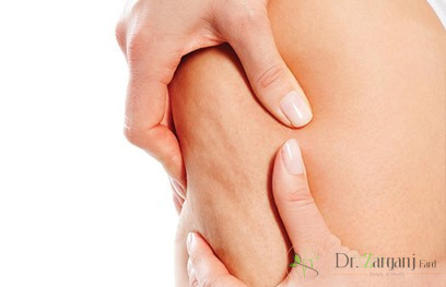 استفاده از روش کربوکسی تراپی برای درمان تیرگی و برآمدگی های کشاله ران نیاز به چند جلسه دارد؟