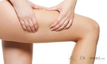 علت تیرگی، سلولیت و دیگر مشکلات کشاله ران چه می تواند باشد؟