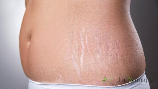مراقبت های بعد از انجام روش کربوکسی تراپی ترک های پوست چیست و تا چه اندازه اهمیت دارد؟