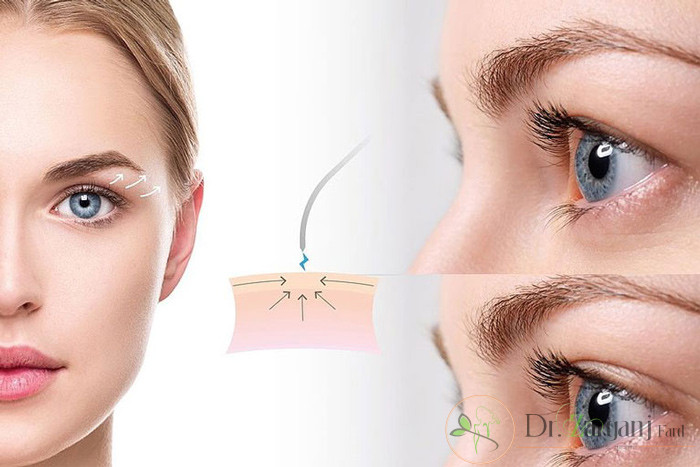 بلفاروپلاستی چیست ؟