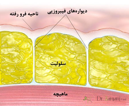 استفاده از کربوکسی تراپی برای درمان سلولیت چه فوایدی دارد؟