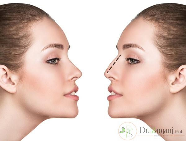 دوره ی نقاهت و ریکاوری تزریق ژل به بینی: