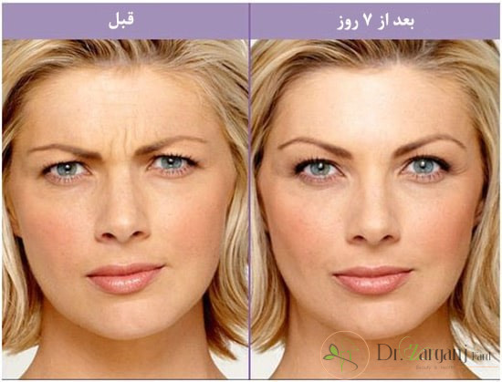 با استفاده از ژل آلوئه ورا و سفیده تخم مرغ خطوط ابرو را به طور کاملا طبیعی بوتاکس کنید: