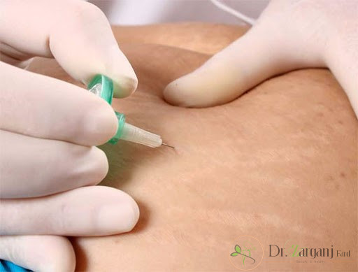 استفاده از روش کربوکسی تراپی برای درمان سلولیت چه نتیجه ای دارد؟