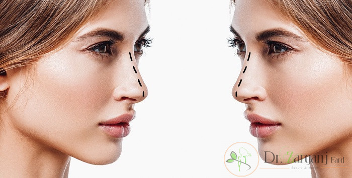 هزینه تزریق ژل به بینی
