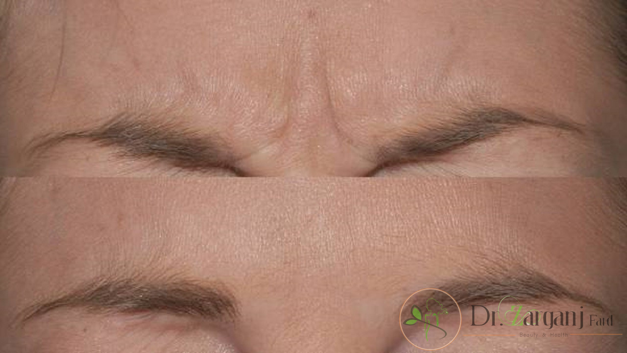 مراجعه منظم به پزشک برای ماندگاری بیشتر بوتاکس