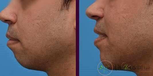 چه کسانی هزینه تزریق ژل به چانه را تقبل می کنند؟