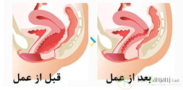 از ویژگی های تنگ کردن واژن با لیزر می توان موارد زیر را نام برد: